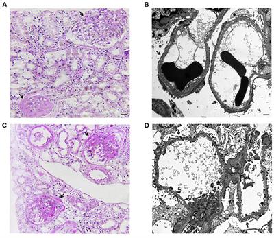 Case Report: The Monogenic Familial Steroid-Resistant Nephrotic Syndrome Caused by a Novel Missense Mutation of NPHS2 Gene A593C in a Chinese Family